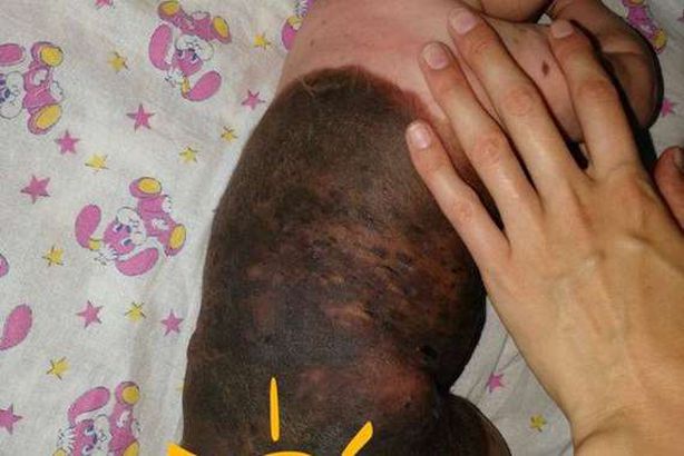 طفلة "الوحمة الشيطانية"