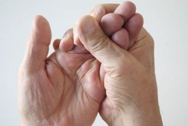 السكتة الدماغية 1