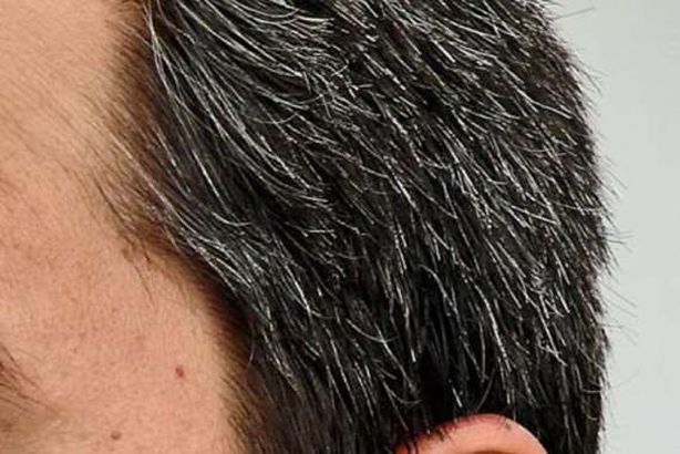 الشيب المبكر