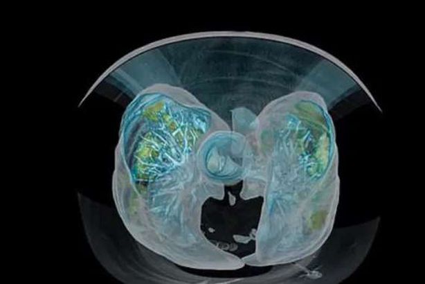 رئة مصابة بكورونا