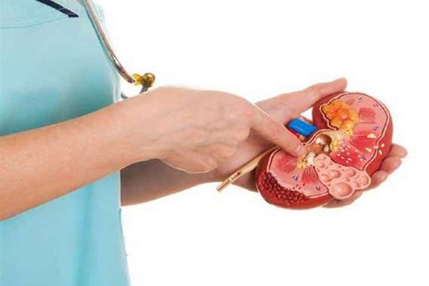 "حصوات" الكلي  

