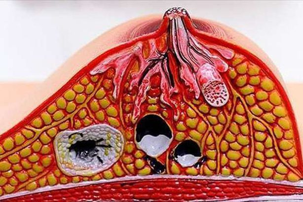سرطان الثدي