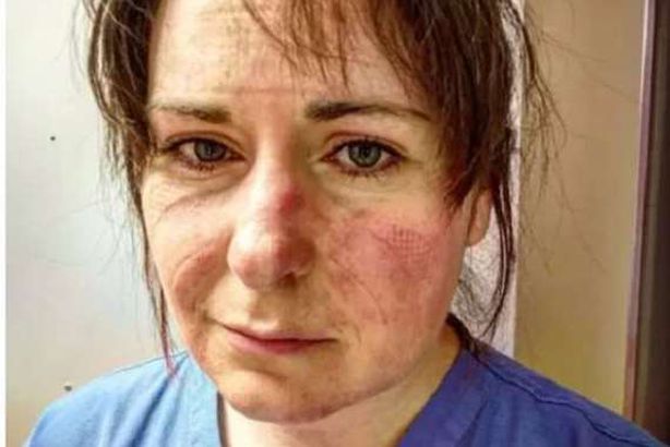 تعاطف معها العالم .. رسالة من ممرضة "القروح غطّت وجهها"