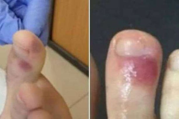 اعراض جديدة لـ"كورونا"