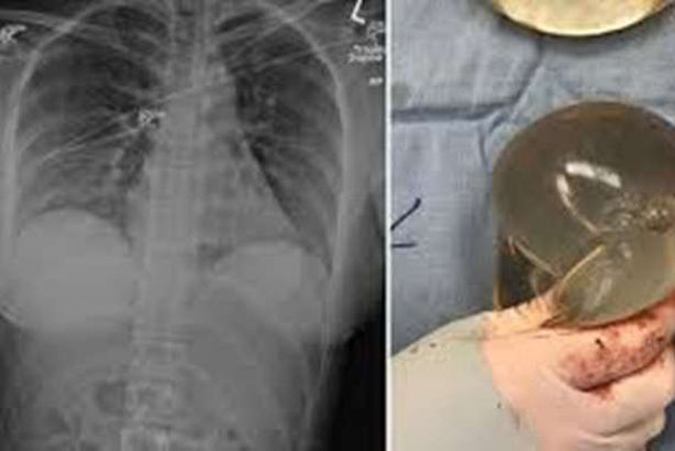 نجاة سيدة من رصاصة قاتلة بسبب حشوة صدر