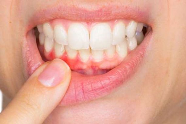 التهاب اللثة