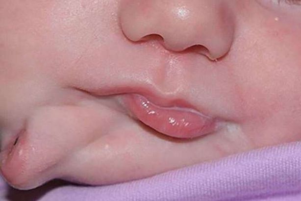 ولدت بفمين..  كيف عالجها الأطباء