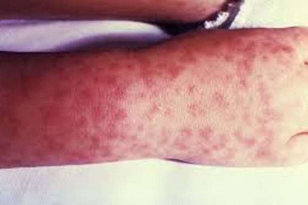 امتداد لكورونا.. وباء جديد يضرب دولة عربية