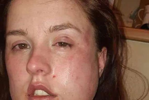 جنون الغيرة.. يعتدي بوحشية على حبيبته في ليلة زفاف أختها
