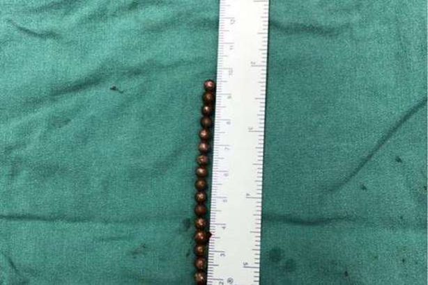 شاهد.. لن تصدق ما أدخله طفله في قضيبه 
