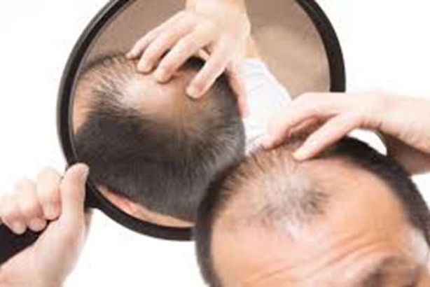 دراسة تكشف مفاجأة عن علاقة الصلع بوفيات كورونا