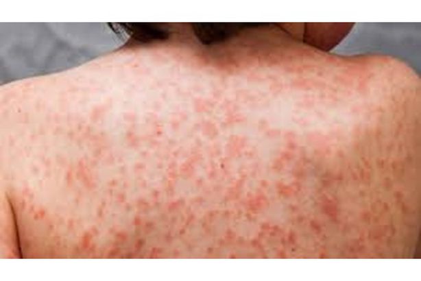 مرض مجهول ينهي حياة العشرات بدولة عربية
