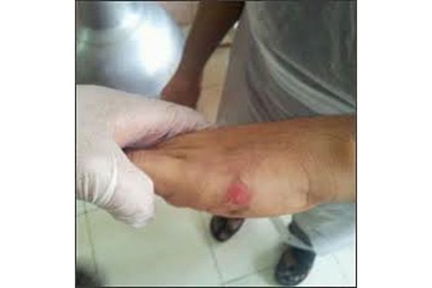 قليل البخت.. أول من شفي من الإيدز يصاب هذا المرض
