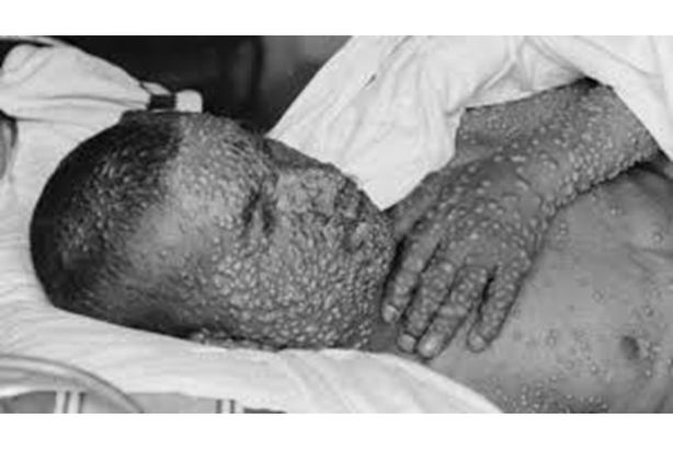 قتل 100 مليون شخص في الماضي.. الطاعون الأسود يظهر في الصين مجددا
