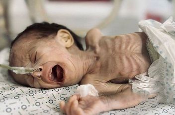 اليونيسيف تحذر من تفاقم سوء التغذية الحاد بين أطفال غزة
