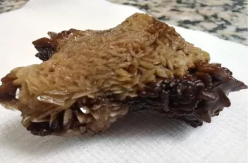 استخراج حصوة كبيرة من الكلى باستخدام المنظار في مأدبا