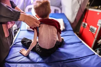 طفل يعاني من سوء التغذية في قطاع غزة
