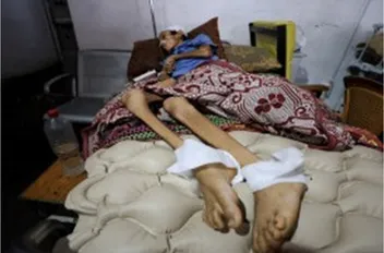 تسجيل حالات الشلل الرخو الحاد بأعداد غير مسبوقة في قطاع غزة