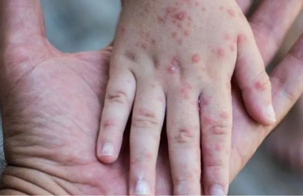 قادمة من الإمارات .. الكيان يعلن تسجيل أول حالة بجدري القرود 