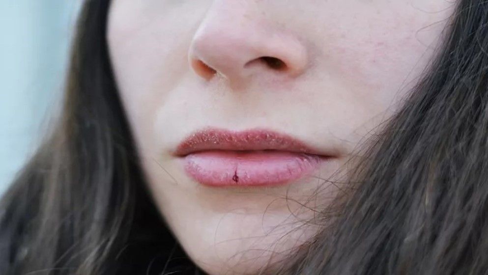 Causes of Chapped Lips and How to Treat Them...