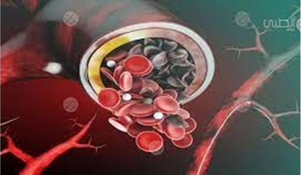 صحة الرياض: 5 نصائح للوقاية من مضاعفات أمراض الدم الوراثية
